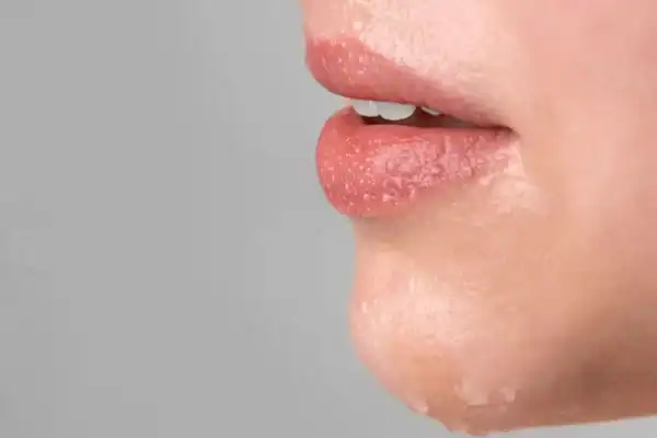 Hidralips