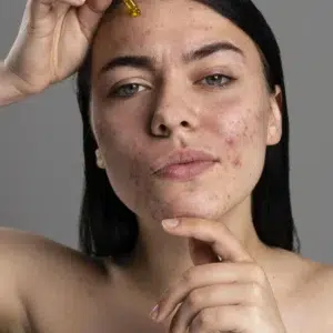 tratamiento para el acné